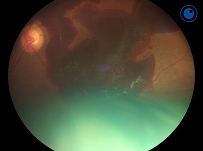 The Benefits of a Handheld Fundus Camera During COVID-19 - Optomed US
