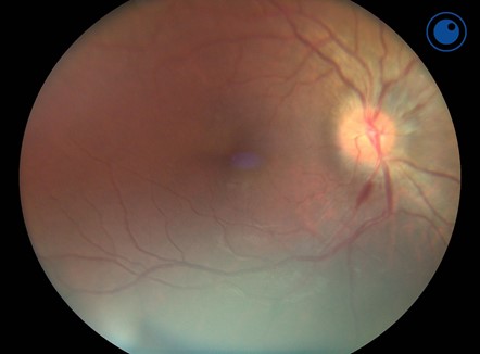 The Benefits of a Handheld Fundus Camera During COVID-19 - Optomed US