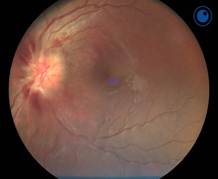 The Benefits of a Handheld Fundus Camera During COVID-19 - Optomed US