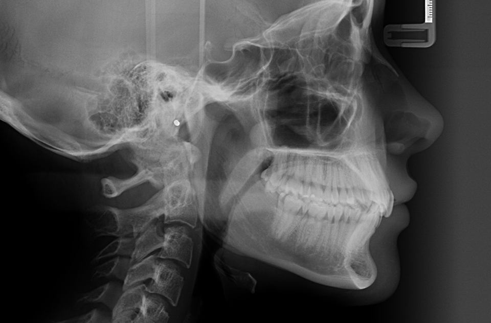 Cephalometry x-ray image