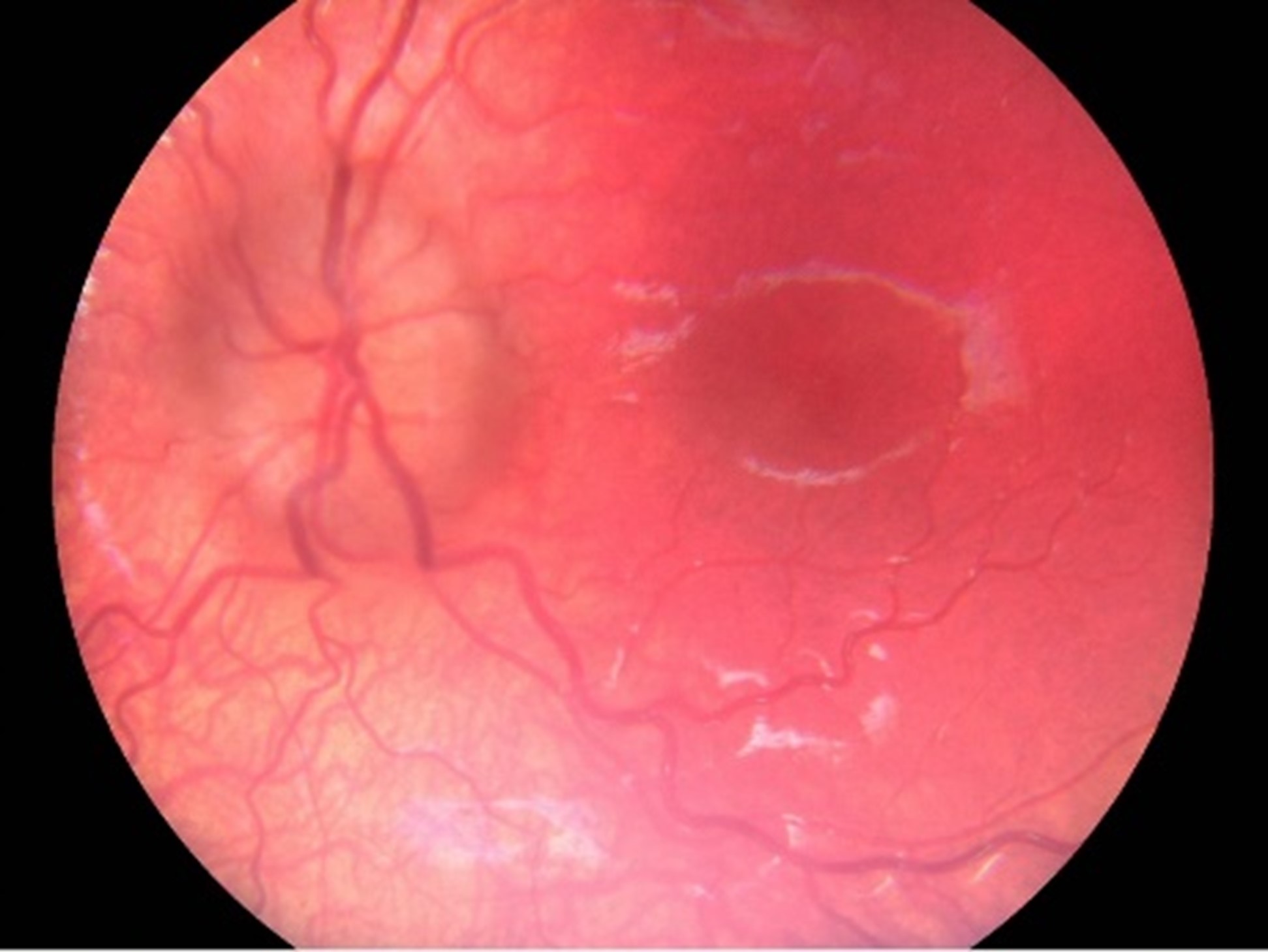 Fundus image showing papilledema.