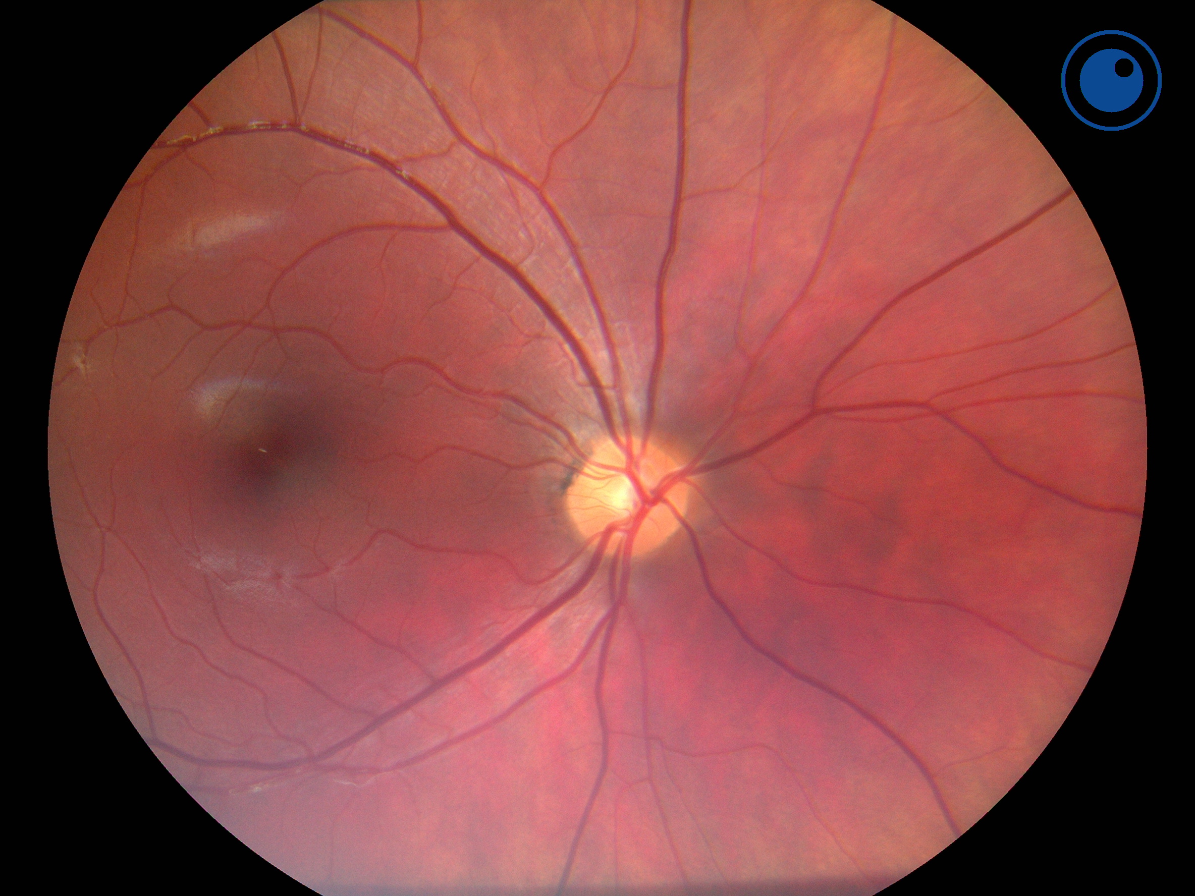 Papilla centered fundus image taken with Optomed Aurora.