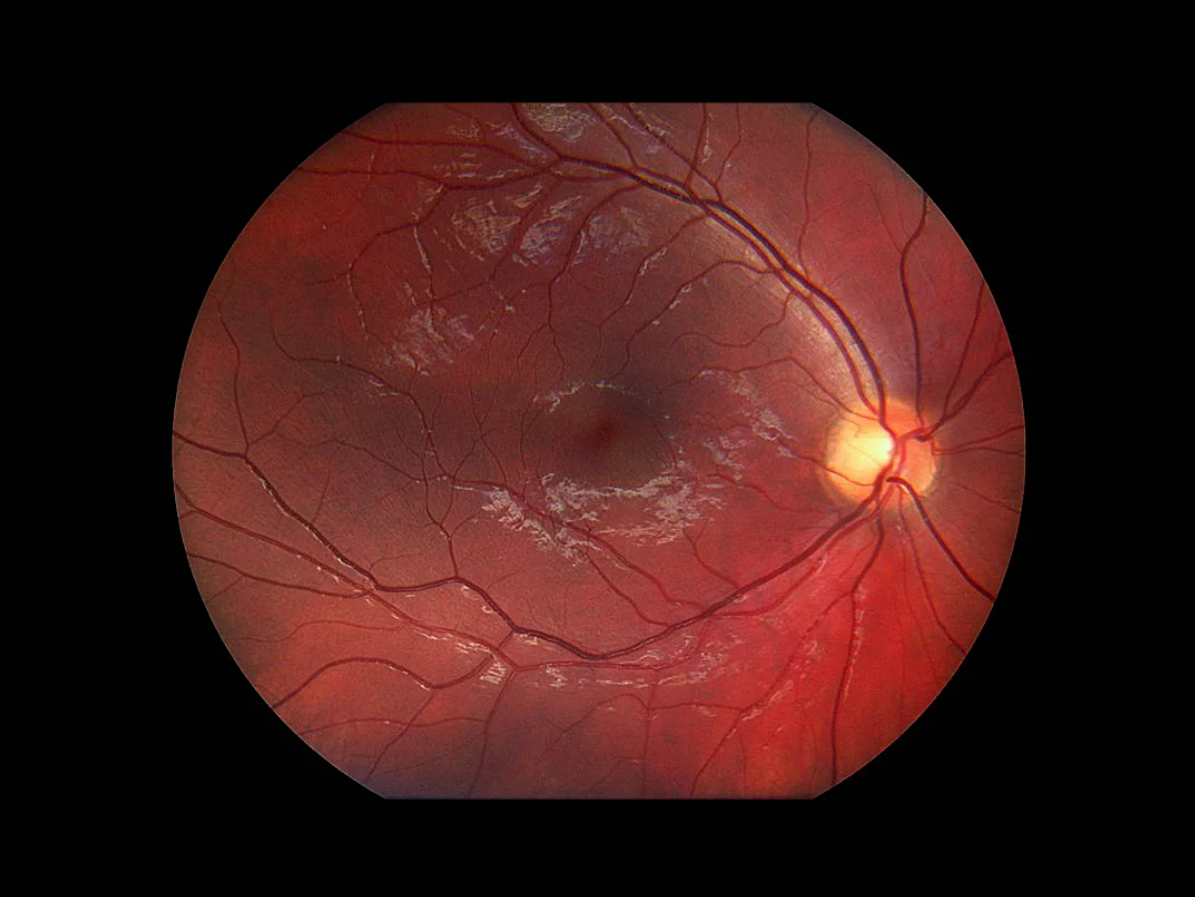 Optomed Aurora IQ ocular fundus image.